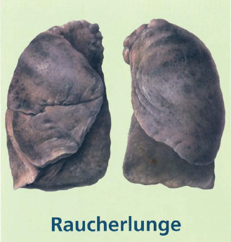 Lungenkrebs durch rauchen!!! Lungenkrebs durch rauchen!!!