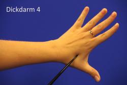 Dickdarm-44