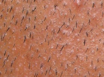 Haarimplantation