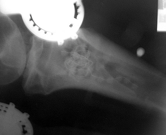 Gentamycin Beads in right Tibia