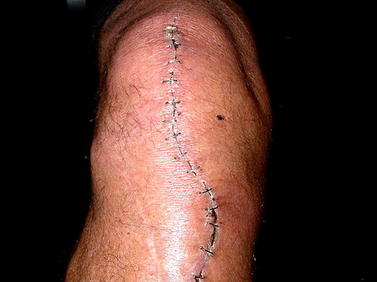 Mein Knie July 08