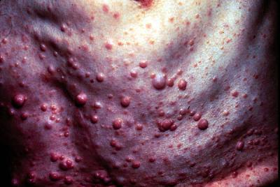 neurofibromatosis