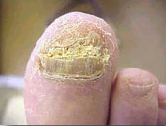 Fungal-Nail-Infection