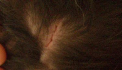 bloodyhead